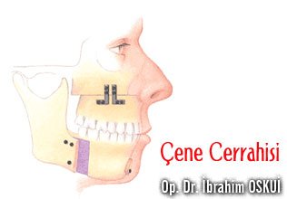 Çene cerrahisi