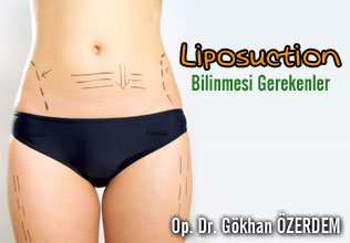 Liposuction hakkında bilinmesi gerekenler