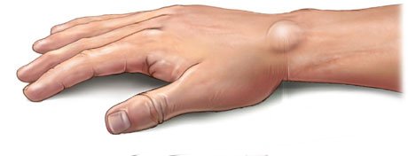 Ganglion nedir ?