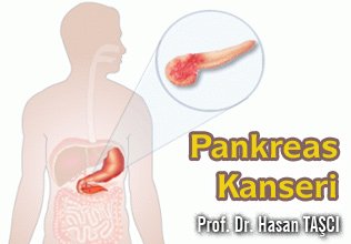 Pankreas kanseri