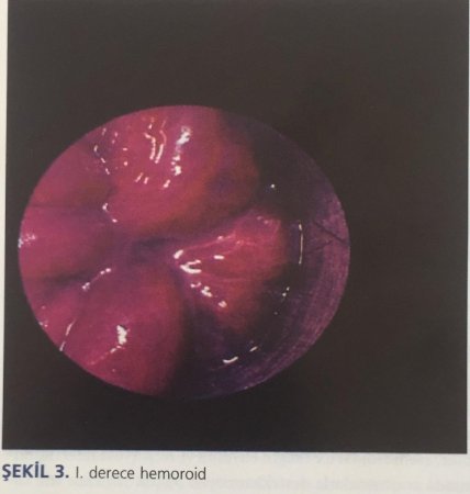 Hemoroidal hastalık