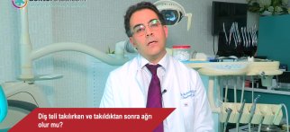 Diş teli takılırken ve takıldıktan sonra ağrı olur mu?