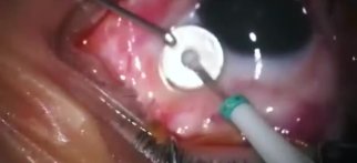 Youtube - Makula Deliği, Kombine Fako Vitrektomi İLM Peeling