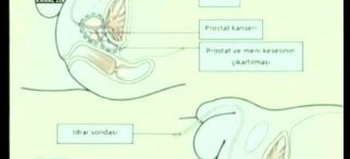 Youtube - Prostat hastalıkları hakkında