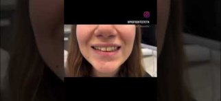 Dişler arasındaki boşluklar dişlere zarar verilmeden tek seansta bonding dolgular ile düzeltilebilir