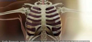 Akciğer Kanserinin Risk Faktörleri Nelerdir? What Are the Risk Factors for Lung Cancer?