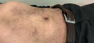 Abdominal aort anevrizması (karın bölgesindeki aort damarının genişlemesi)