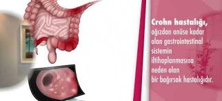 Crohn hastalığı nedir? Crohn hastalığı nasıl tedavi edilir? - Doç. Dr. Tolga Konduk