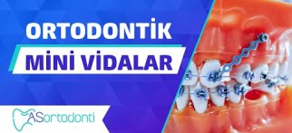 Ortodontik Mini Vidalar Ne İşe Yarar?