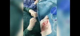 Doğumsal Kalp Hastalığı(ASD), Kapalı Yolla Tedavi Edildi.