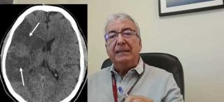 İnme Nedir? Prof. Dr. Kürşad Kutluk