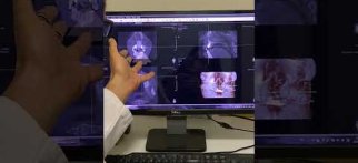 Dijital Tomografi Yorumları-İmplant Kaynamış