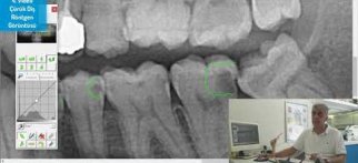 Çürük Diş Röntgen Görüntüsü