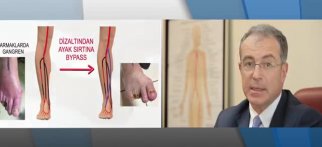 Şeker hastalarındaki ayak yaraları nasıl tedavi edilir?