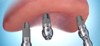 Bar Clip Overdenture (Implant Supported)
