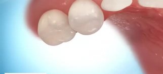 Progression of Decay, Occlusal (primary molars)