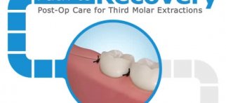 Post Operative Care (third molar extraction)