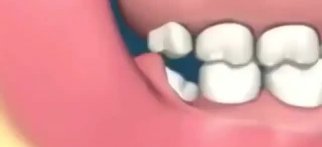 Youtube - Yirmiyaş dişleri komşu dişlerde çarpıklık, çene ve ağız ağrısı, yutkunmada zorlanma ve kist oluşumu