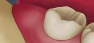 Youtube - Gömülü 20'lik diş operasyonu