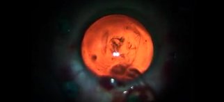 Youtube - Dev Yırtıklı Retina Dekolmanı Cerrahisi