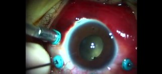Youtube - Marfan Sendromu Lens Lüksasyonu ve Retina Dekolmanı Cerrahisi