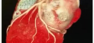 Youtube - Bilgisayarlı tomografik (sanal anjio) anjio ile kalbin ve koroner damarların üç boyutlu görüntüsü