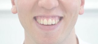 Youtube - Gülümsediğinizde diş etlerinizin aşırı görünmesi sizi rahatsız mı ediyor?