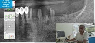 İltihaplı Diş Röntgen Görüntüsü