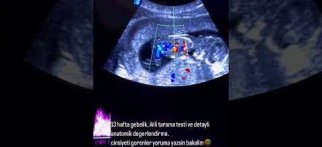 13 haf. gebelik ,ikili tarama testi ve detaylı anatomik değerlendirme.