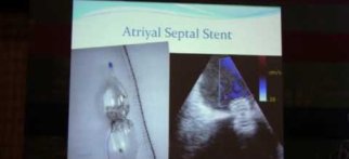 Pulmonary Hypertension, Intervention, Atrial Stent, Potts shunt; pulmonary artery denervation