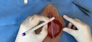 Labioplasti Ameliyatı Nasıl Yapılır ? - Doktor İrem Yengel