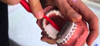 Ortodontik Tedavide Diş Fırçalama | AS Ortodonti
