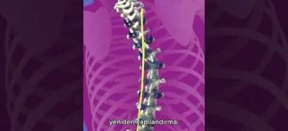 Skolyozda Klasik Ameliyatın (Füzyon) Özellikleri Nelerdir?