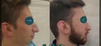 Burun Estetiği Öncesi Sonrası