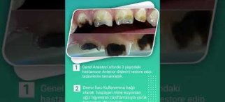 Genel Anestezi altında anterior dişlerin restore edilmesi