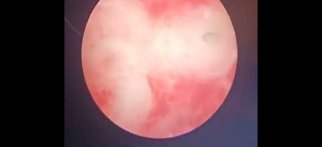 Histeroskopi ile endometrial polip tedavisi