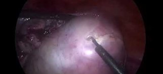 Kapalı Yöntemle Yumurtalık Korunarak Dermoid Kist Ameliyatı #yumurtalik #laparoskopikcerrahi
