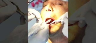 Implant işlemi nasıl gerçekleşiyor?