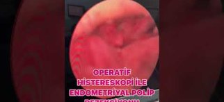 Operatif Histeroskopi İle Endometriyal Polip Rezeksiyonu 👌🏻