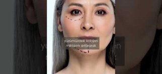 Yüzdeki Sarkmaların Önüne Geçmek Mümkün Mü?