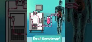 Sıcak Kemoterapi Nedir ? Prof. Dr. Emel CANBAY