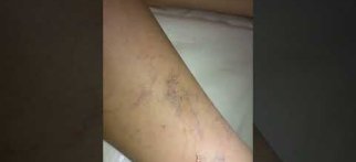 Skleroterapi-Köpük Tedavisi-Varis Tedavisi